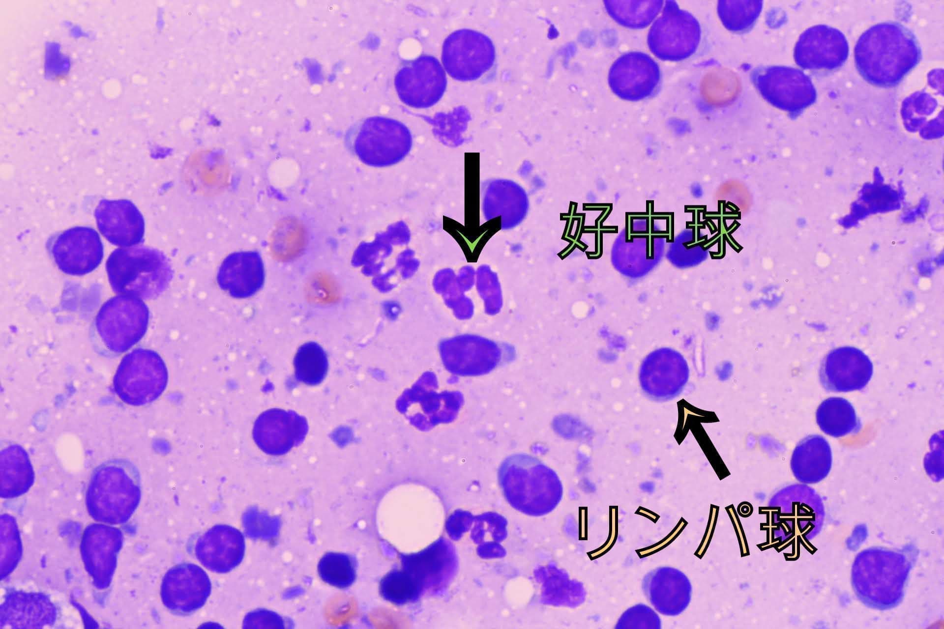 リンパの細胞検査 顕微鏡写真