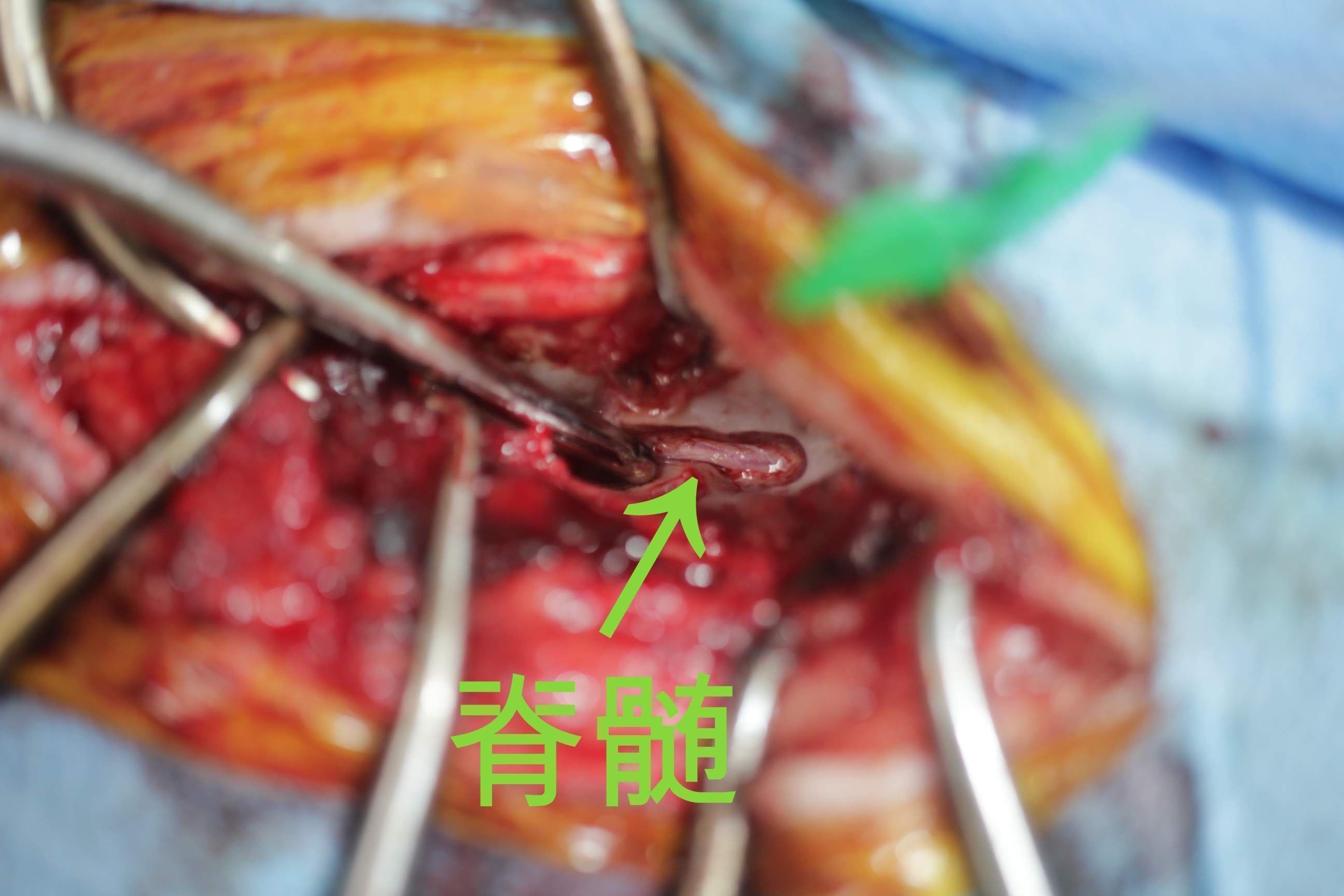 片側椎弓切除術